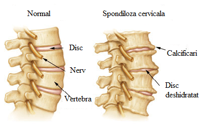tratamentul netradițional al coloanei vertebrale)